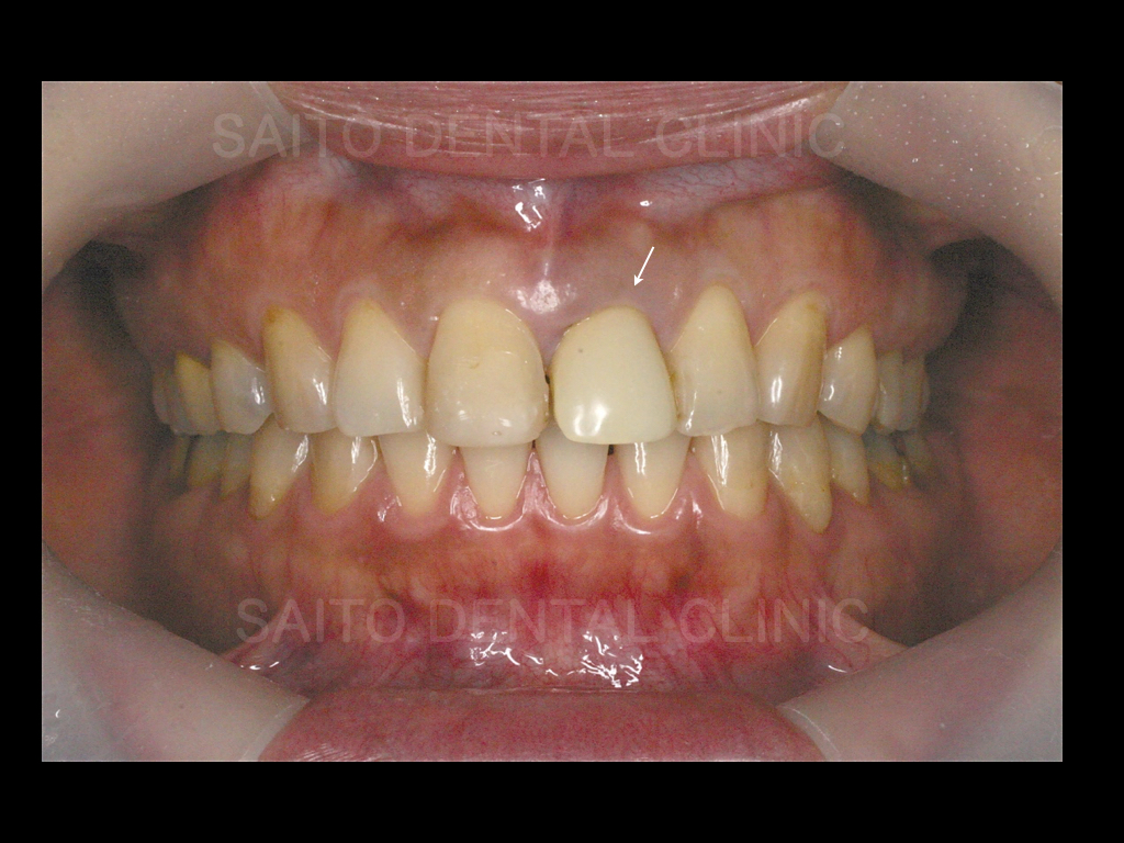 折れてしまった前歯をインプラント治療（難症例）