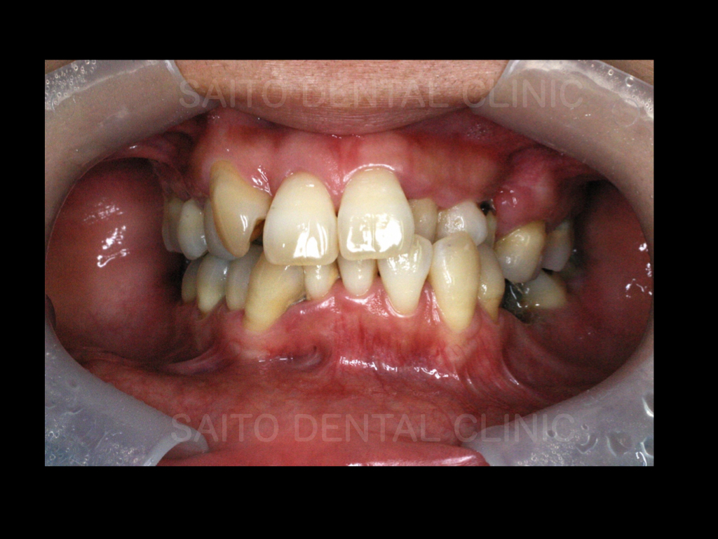 歯周病や虫歯、欠損、歯並びを包括的に治療した症例（難症例）