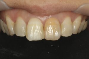 前歯の変色をセラミックで自然に改善｜周囲の歯と完全に調和した審美治療症例